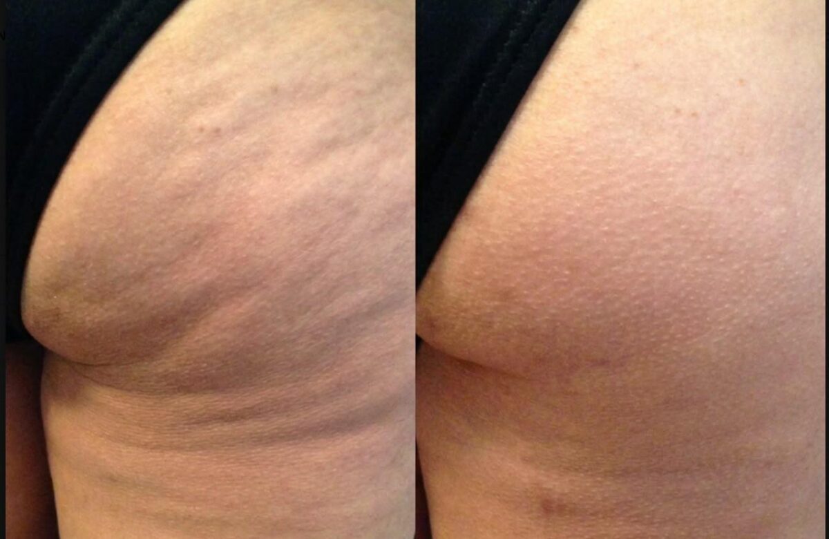 LA CELULITIS AFECTA HASTA AL 90 % DE LAS MUJERES: NEW BODY LANZA “NO MÁS CELULITIS EN COLOMBIA”